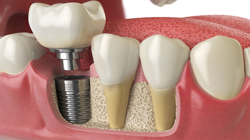 What to expect during a dental implant procedure